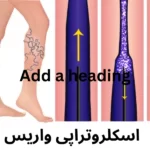اسکلروتراپی-واریس چیست
