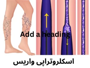 اسکلروتراپی-واریس چیست