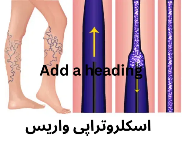 اسکلروتراپی واریس
