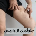 جلوگیری از واریس