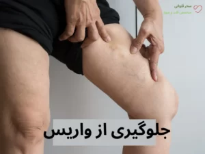 جلوگیری از واریس