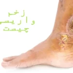 زخم واریس