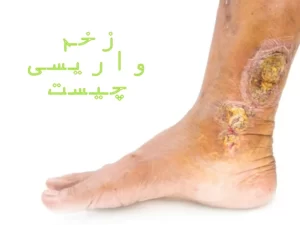 زخم واریس