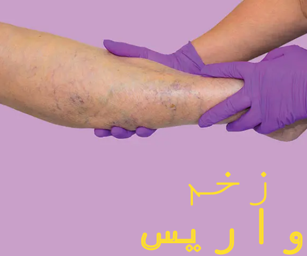 زخم واریسی چیست