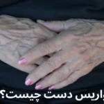 واریس دست