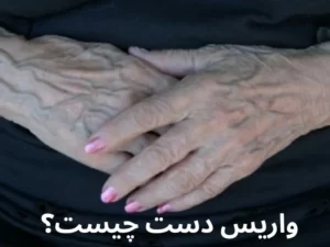 واریس دست