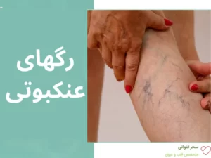 واریس عنکبوتی