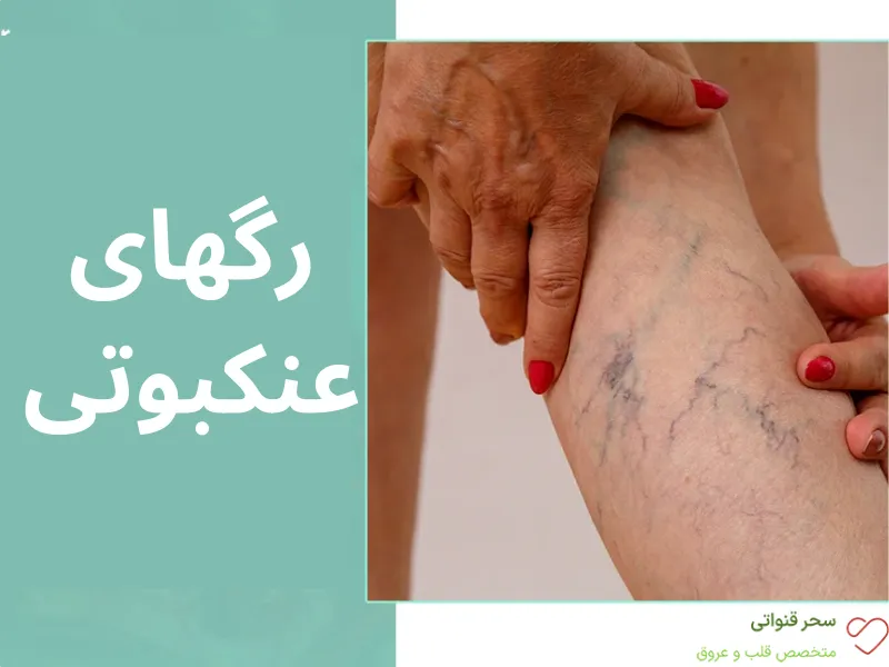 واریس عنکبوتی