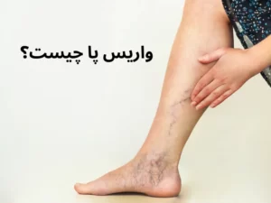 واریس پا