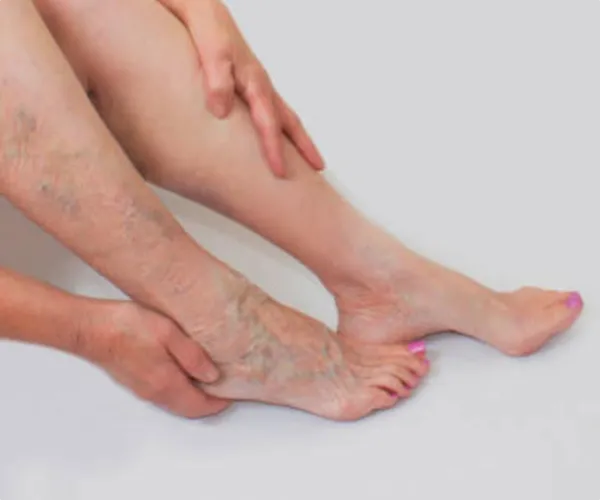 عکس واریس در بارداری