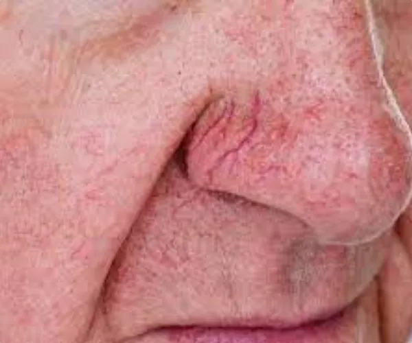 عکس واریس صورت 2