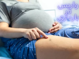 واریس در بارداری