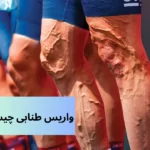 واریس-طنابی
