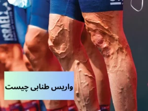 واریس-طنابی