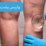 واریس پشت زانو