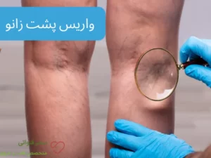 واریس پشت زانو