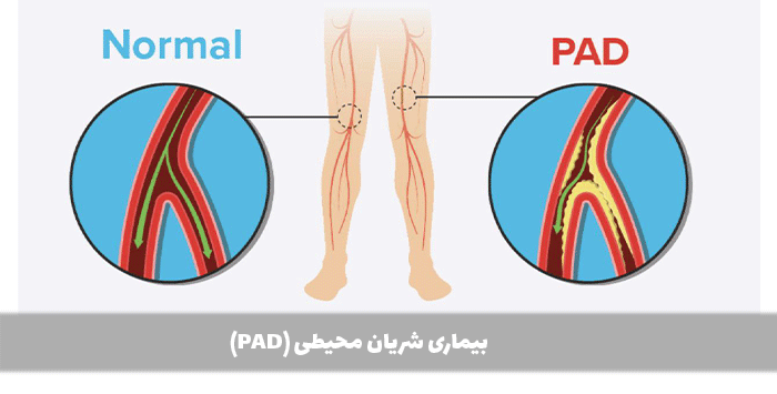بیماری شریان محیطی (PAD)