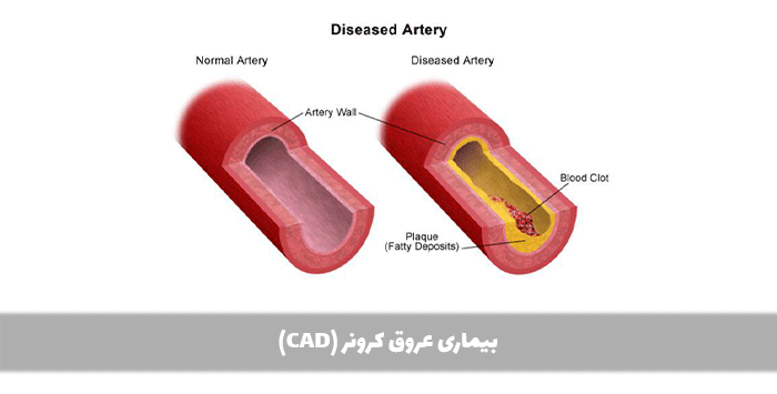 بیماری عروق کرونر (CAD)