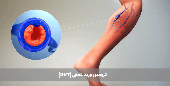 ترومبوز ورید عمقی (DVT)