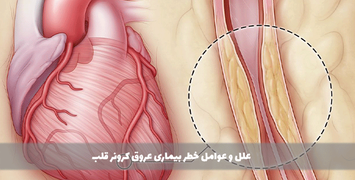 علل و عوامل خطر بیماری عروق کرونر قلب

