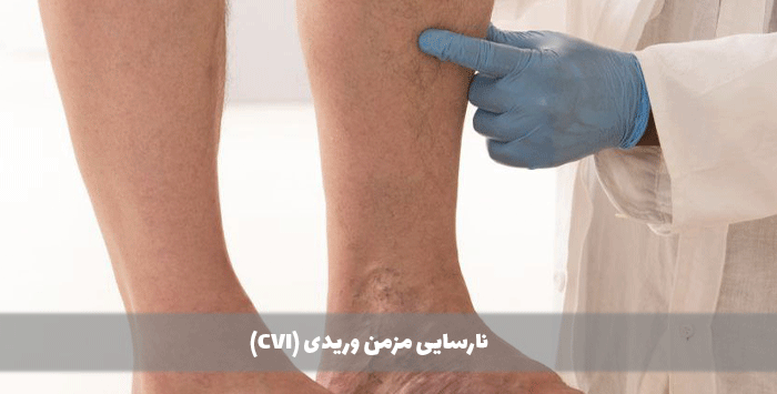 نارسایی مزمن وریدی (CVI)