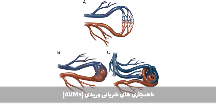 ناهنجاری های شریانی وریدی (AVMs)