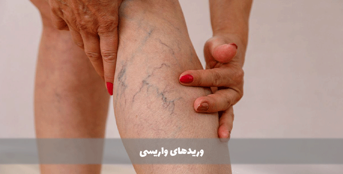  وریدهای واریسی