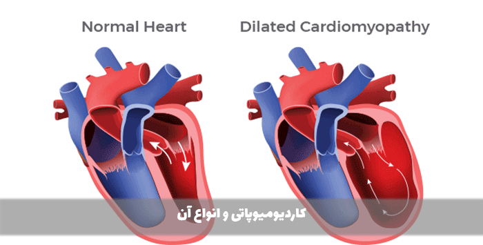 کاردیومیوپاتی و انواع آن
