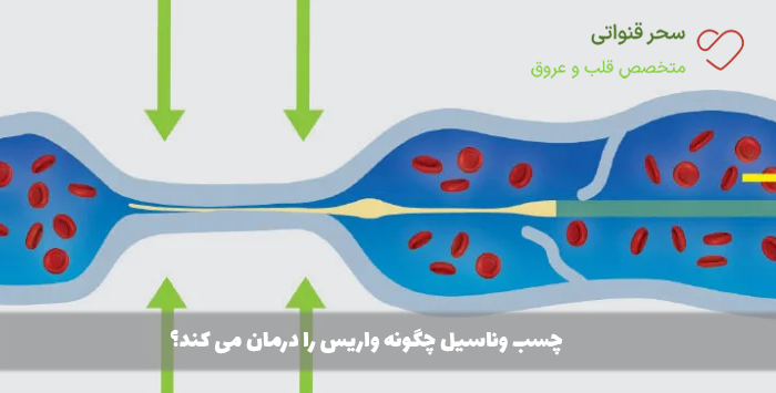 چسب وناسیل چگونه واریس را درمان می کند؟