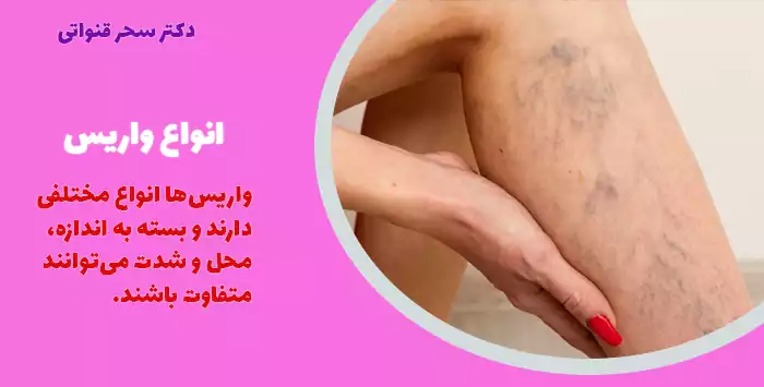 انواع واریس