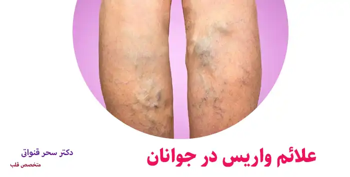 علائم واریس در جوانان