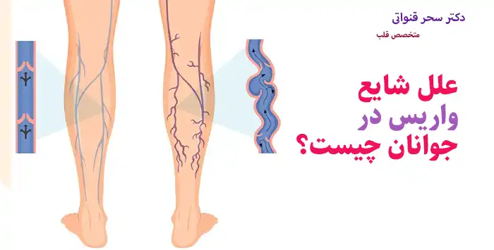 علل شایع واریس در جوانان چیست؟
