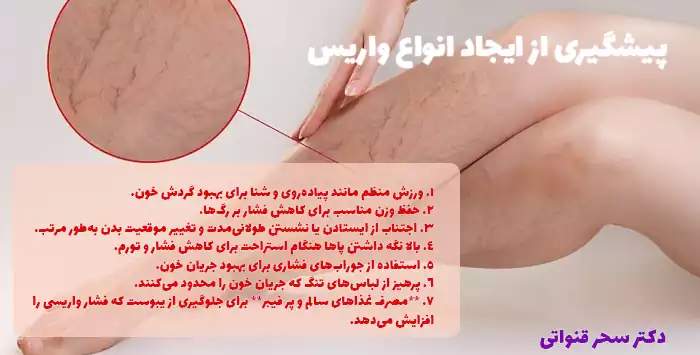 پیشگیری از ایجاد انواع واریس